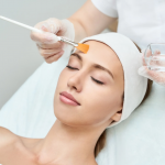 Chemical Peels For Acne: Everything You Need To Know About